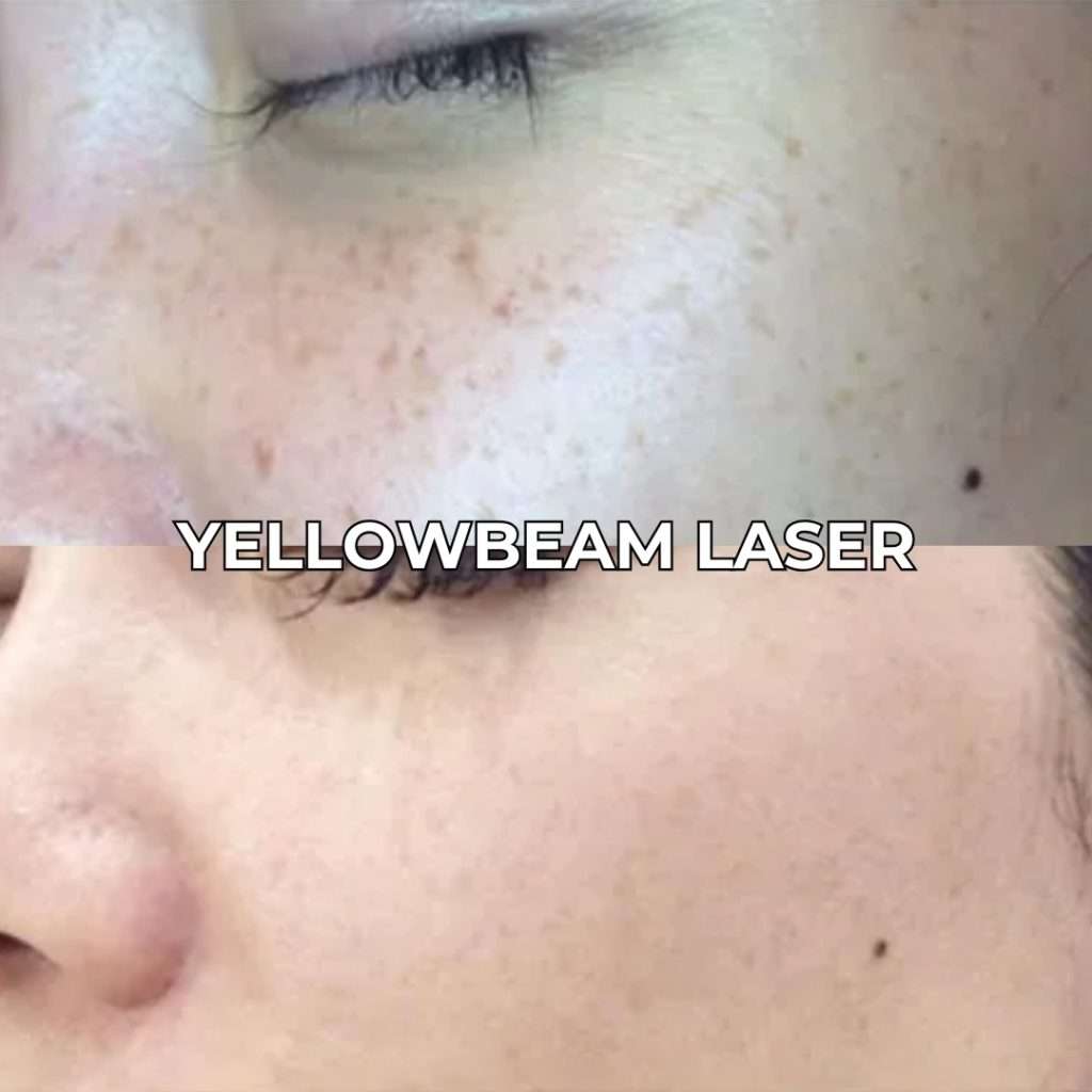 Yellowbeam Laser for Hyperpigmentation Treatment - Toronto & GTA