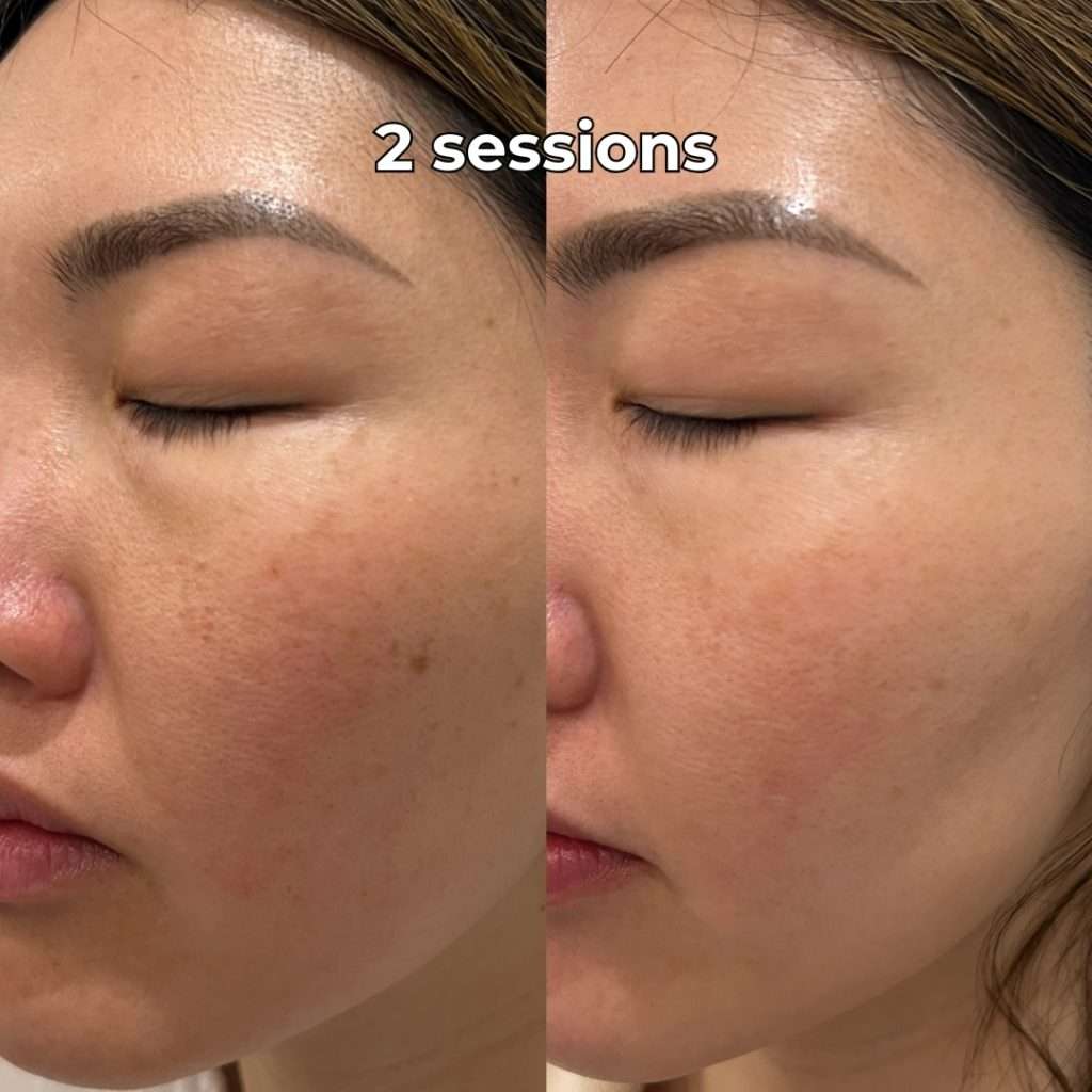 Yellowbeam Laser for Hyperpigmentation Treatment - Toronto & GTA