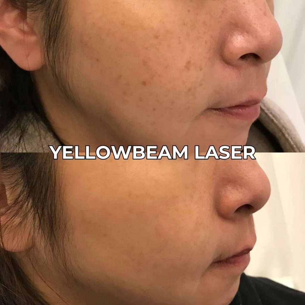 Yellowbeam Laser for Hyperpigmentation Treatment - Toronto & GTA