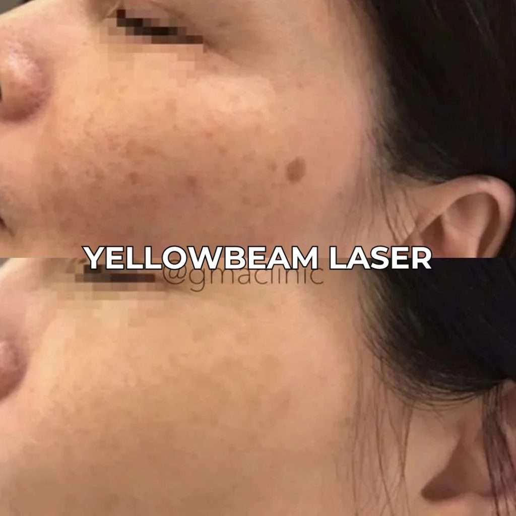 Yellowbeam Laser for Hyperpigmentation Treatment - Toronto & GTA